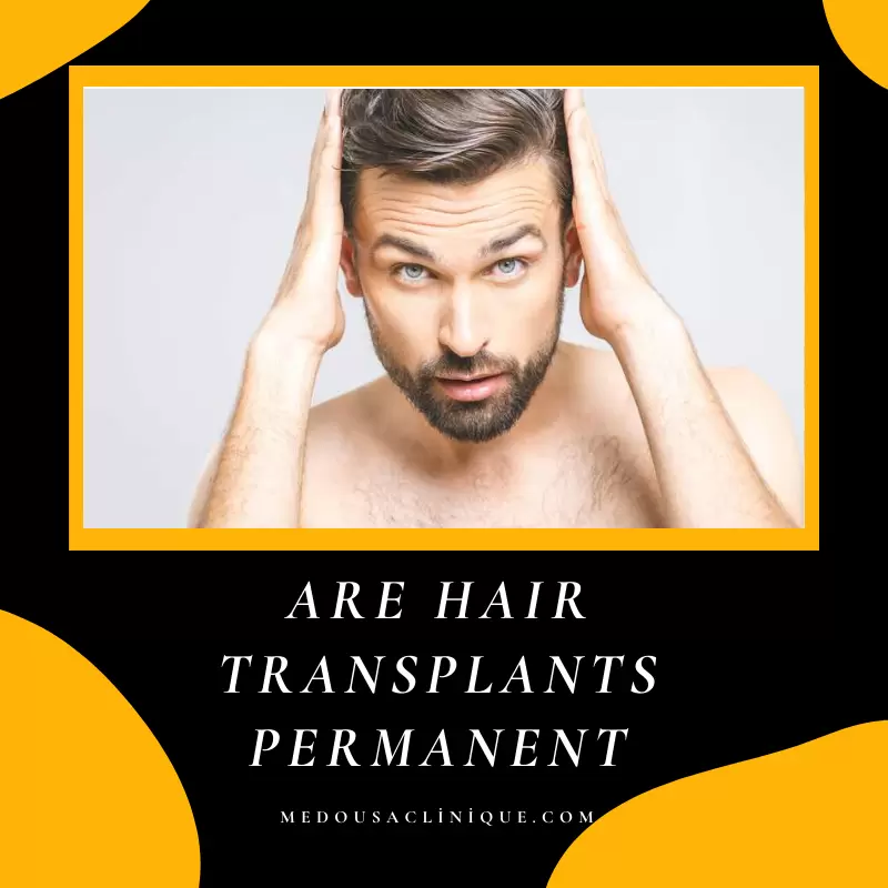 ARE HAIR TRANSPLANTS PERMANENT