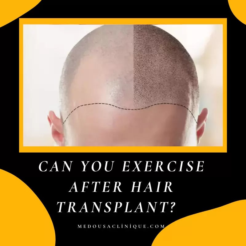 CAN YOU EXERCISE AFTER HAIR TRANSPLANT?