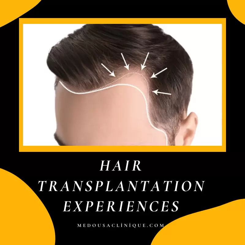 HAIR TRANSPLANTATION EXPERIENCES