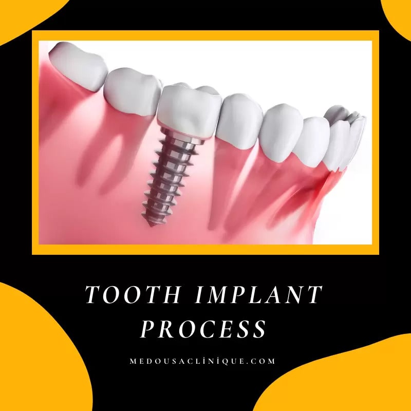 TOOTH IMPLANT PROCESS