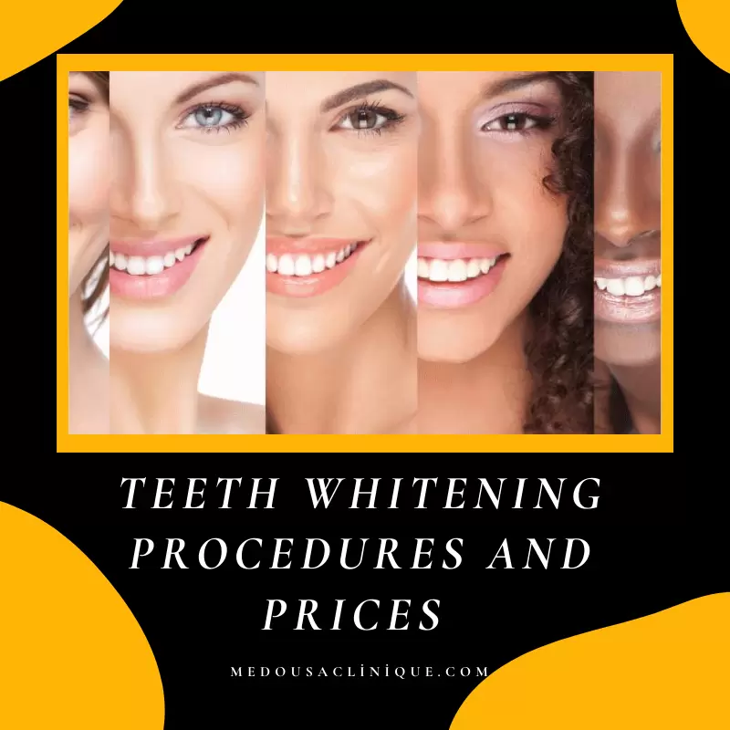 Teeth Whitening Procedures And Prices