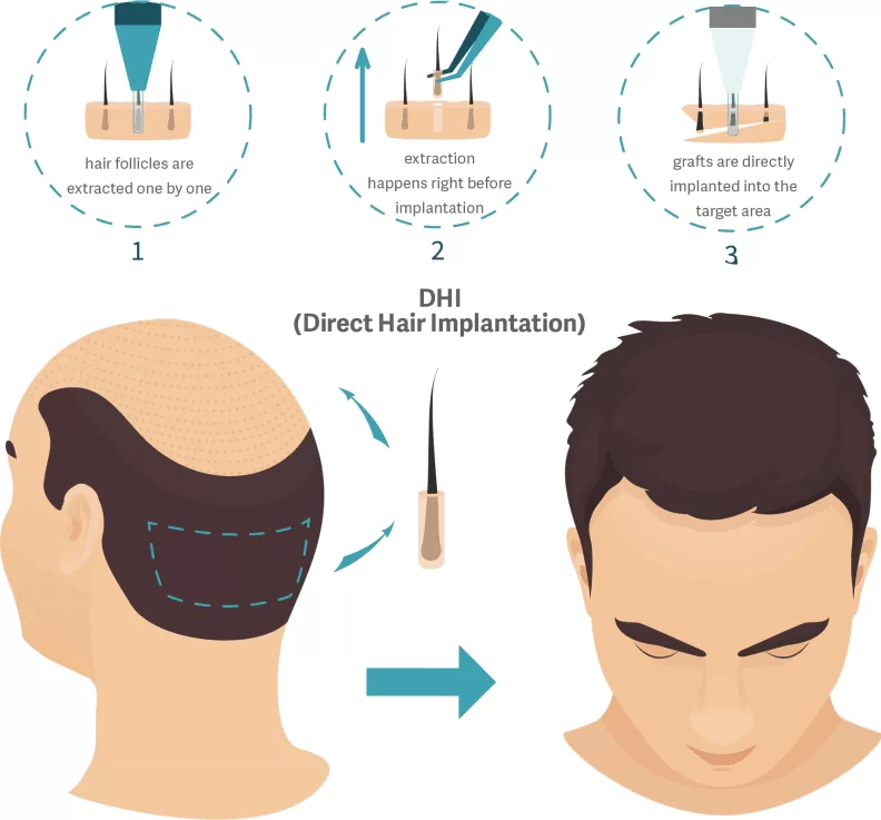 DHI Method Hair Transplant - Medousa Clinique