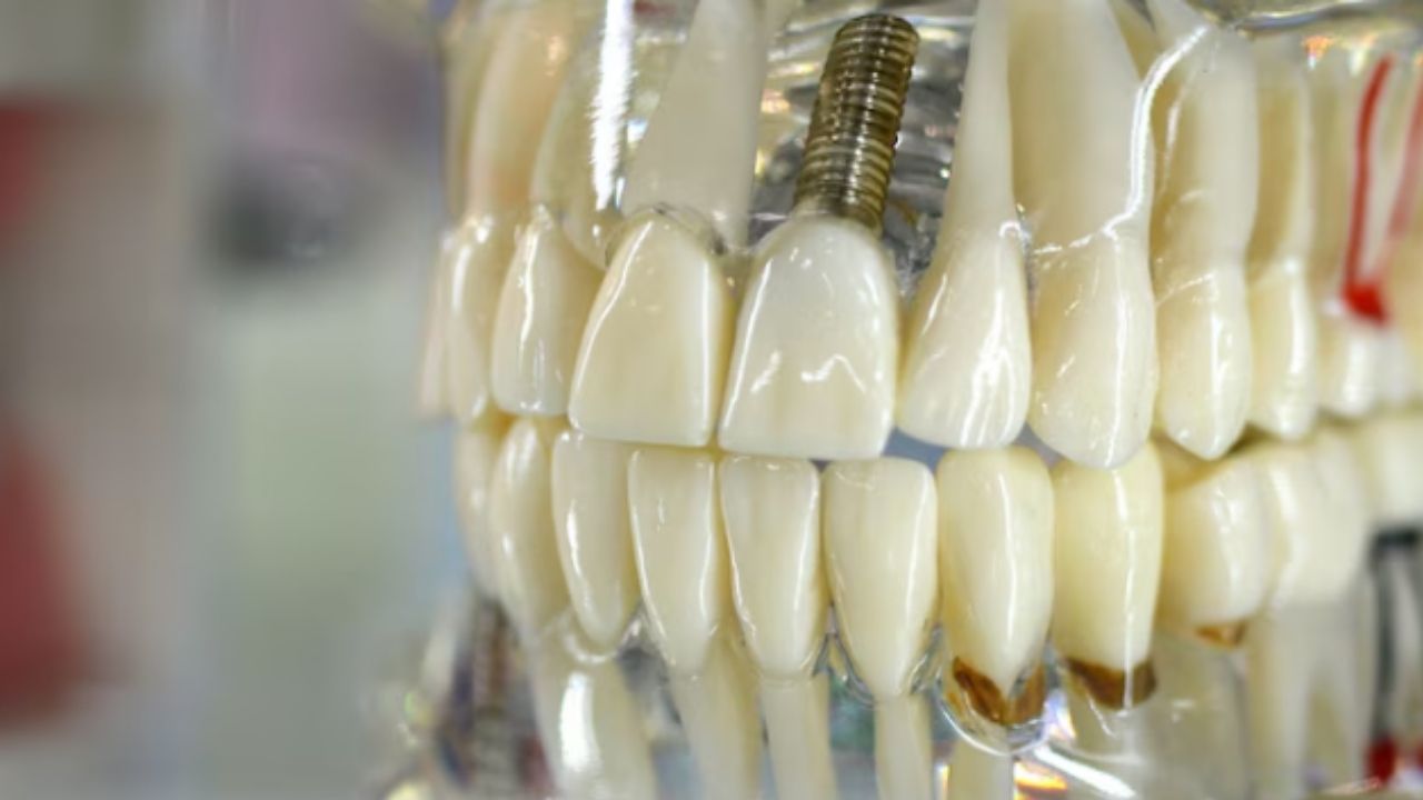 zirconium-dental-implants (1)