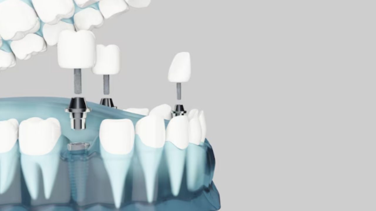 zirconium-dental-implants (2)