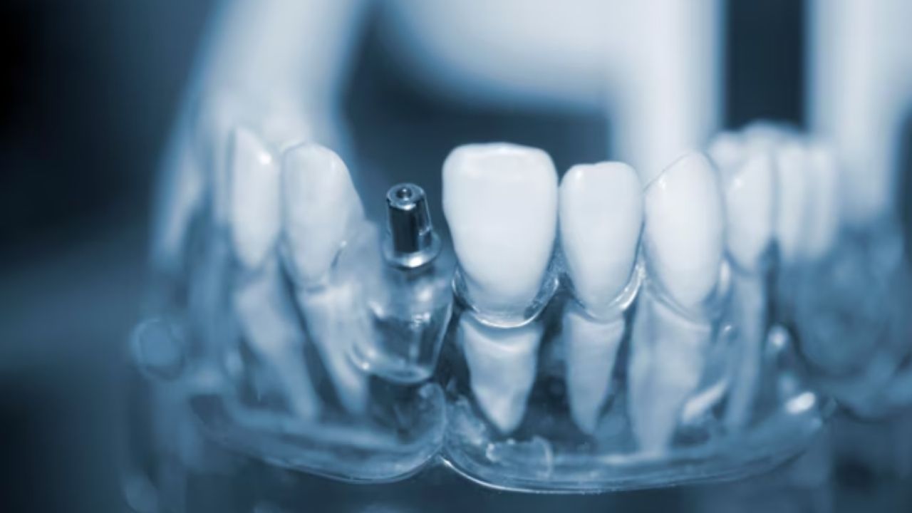 zirconium-dental-implants